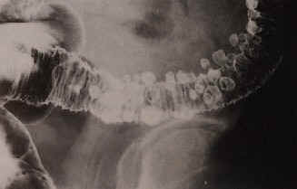 divertikel des dickdarmes