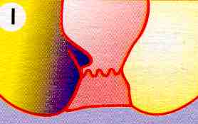 Hämorrhoiden Stadium 1