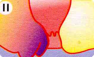 Hämorrhoiden Stadium 2