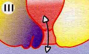 Hämorrhoiden Stadium 3