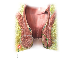 FiLaC® - Fistula-tract Laser Closure
