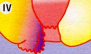 Hämorrhoiden Stadium 4