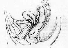 Rectocele und Mastdarmvorfall